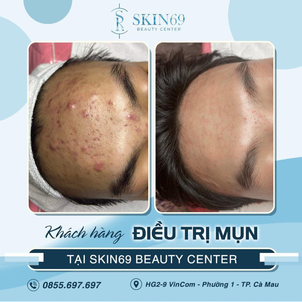 Có nên đi nặn mụn ở Spa không? Có nên nặn mụn ẩn ở Spa?