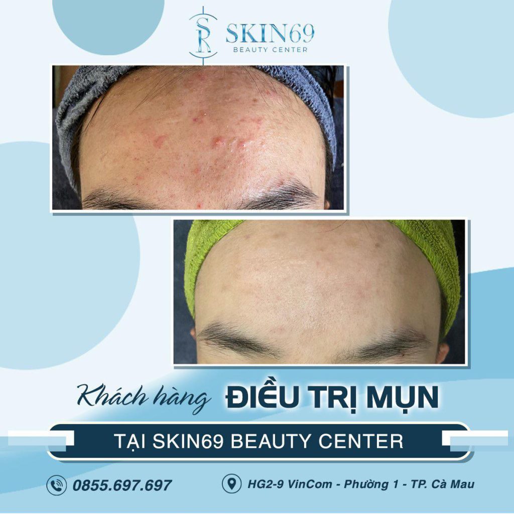Nặn mụn ở Cà Mau Spa Uy Tín chuẩn Y Khoa
