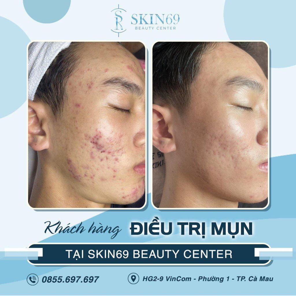 Tuổi dậy thì có nên đi Spa nặn mụn không?
