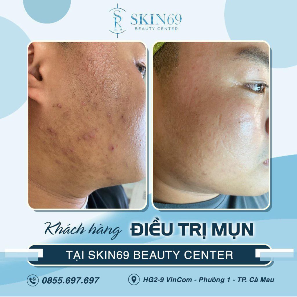 Meso No Needle là gì? Làm đẹp bằng phương pháp meso KHÔNG kim