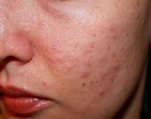 Trị mụn Demodex Cà Mau | Triệu chứng demodex